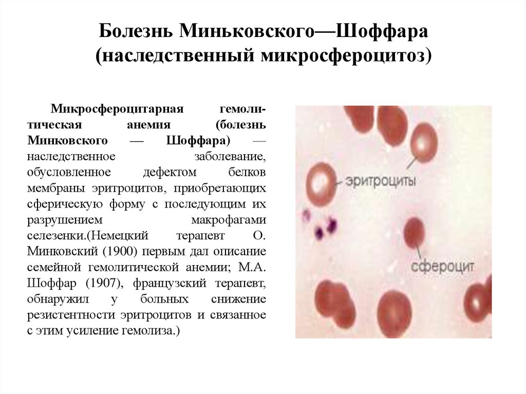Изменение крови при заболеваниях. Болезнь Минковского Шоффара. Наследственный микросфероцитоз (болезнь Минковского-Шоффара). Анемия Минковского-Шоффара патогенез. Наследственный сфероцитоз картина крови.
