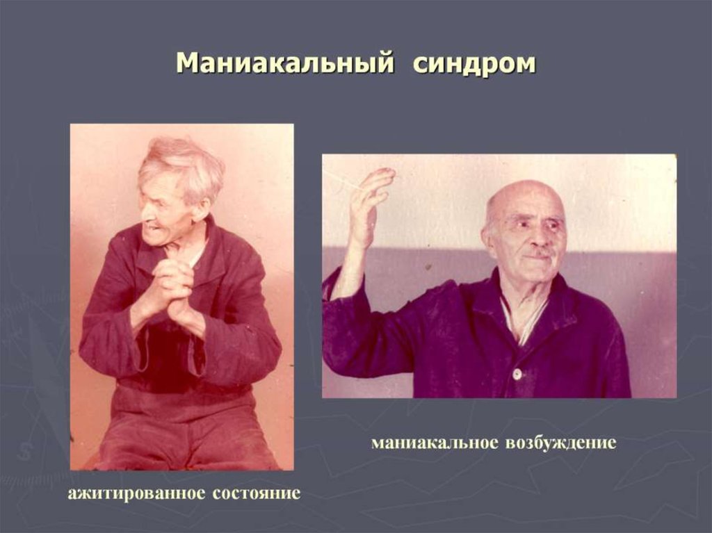 Синдром мания. Маниакальный синдром. Маниакальное состояние психиатрия. Маниакальное возбуждение.