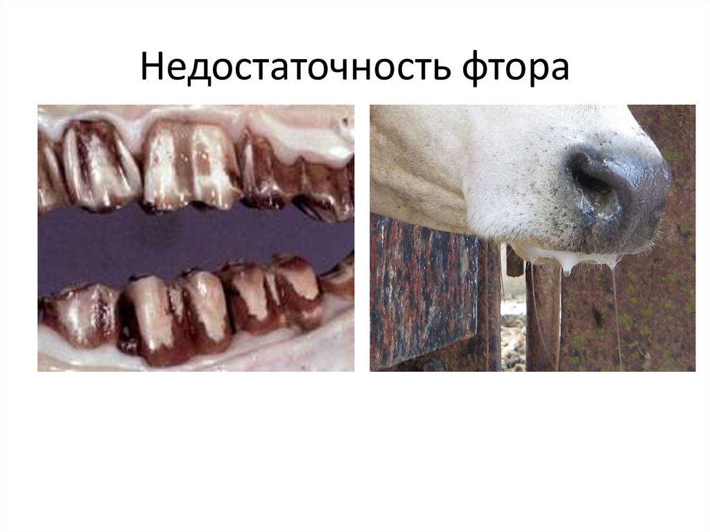 Недостаточность фтора