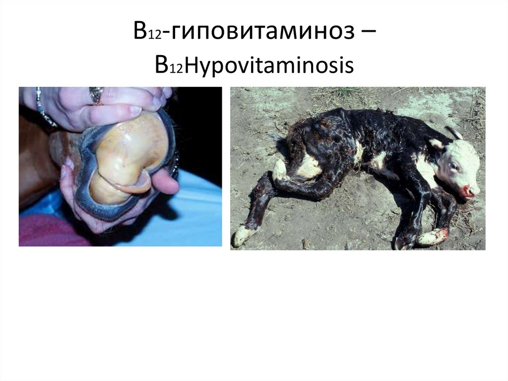 В12-гиповитаминоз – В12Hypovitaminosis