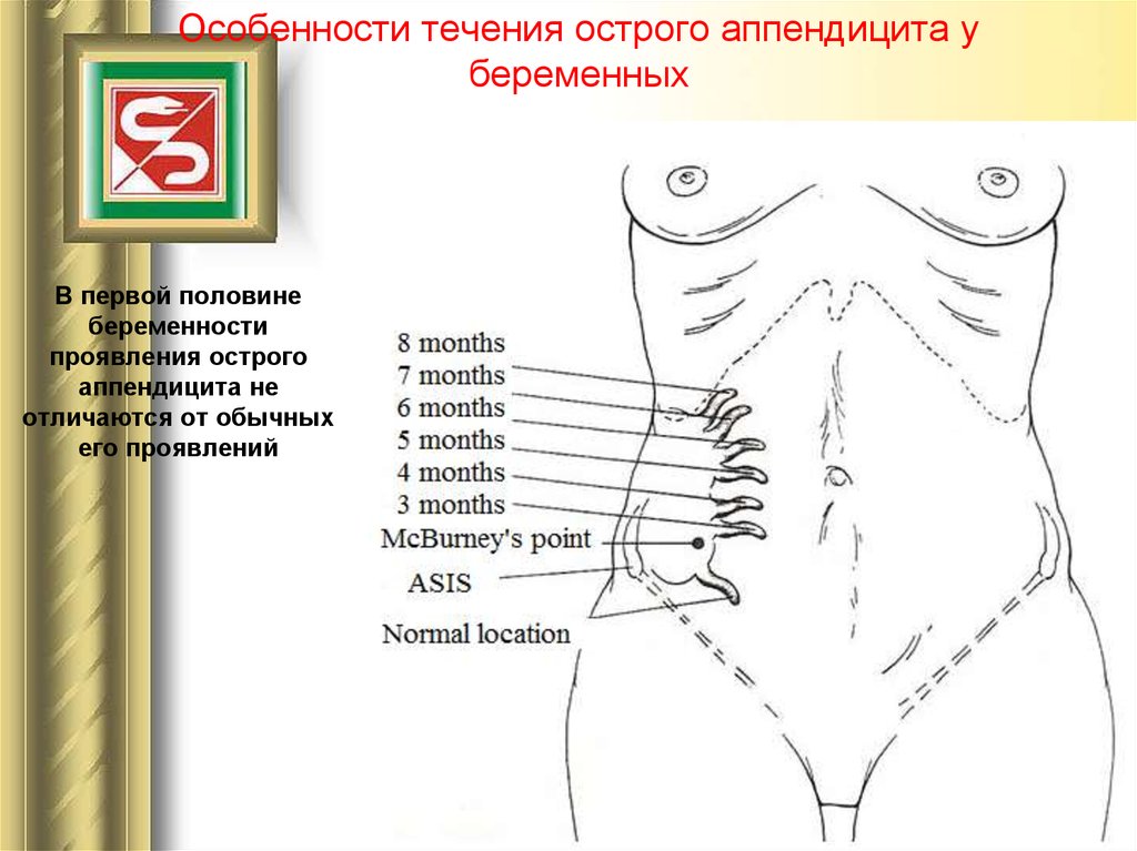 Как болит аппендицит. Расположение аппендикса у беременных. Расположение аппендикса у женщин. Особенности течения острого аппендицита у беременных. Острый аппендицит у женщин.