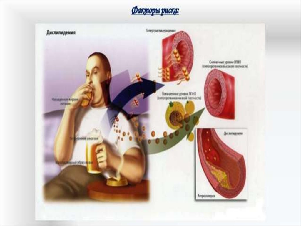 Атеросклероз факторы риска. Атеросклероз сосудов факторы риска. Постер профилактика облитерирующего атеросклероза. Атеросклероз у беременных презентация. Атеросклероз рисунок на ватмане.