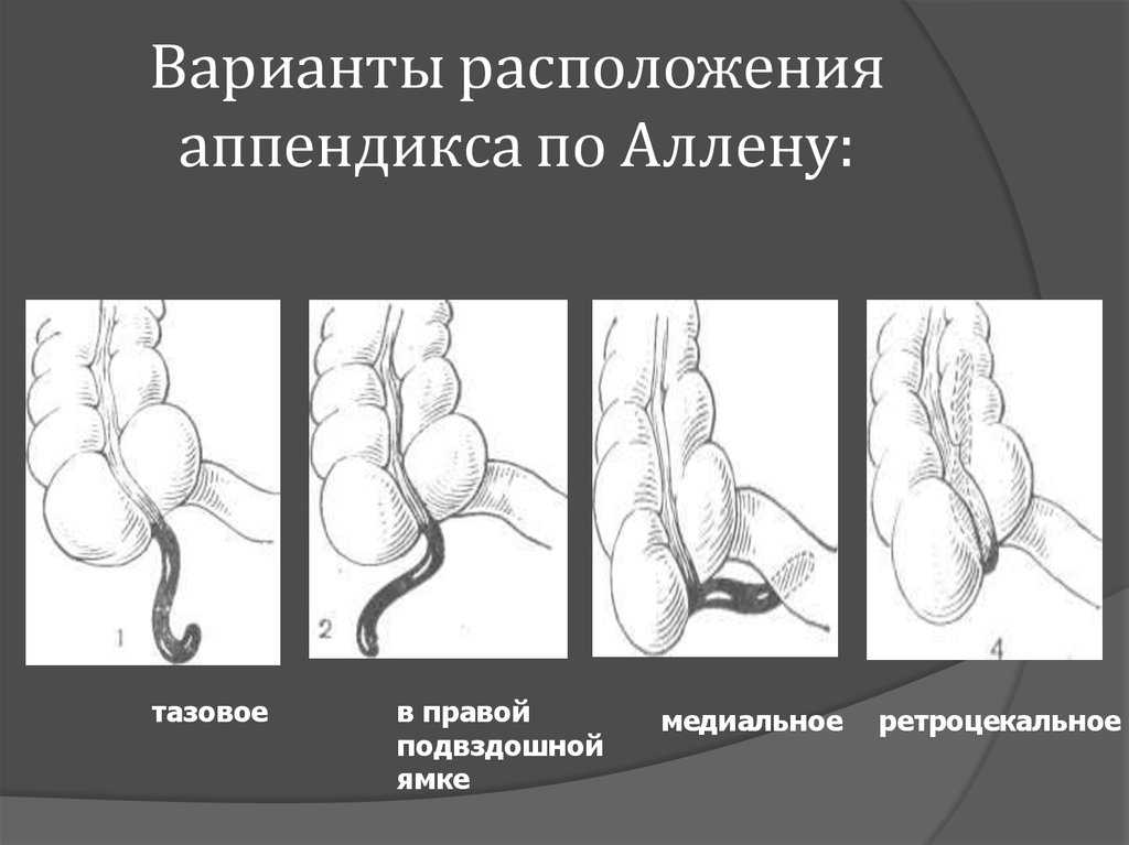 Особенности клинической картины острого аппендицита при тазовом расположении червеобразного отростка