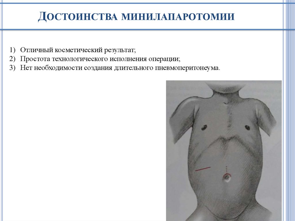 Достоинства минилапаротомии
