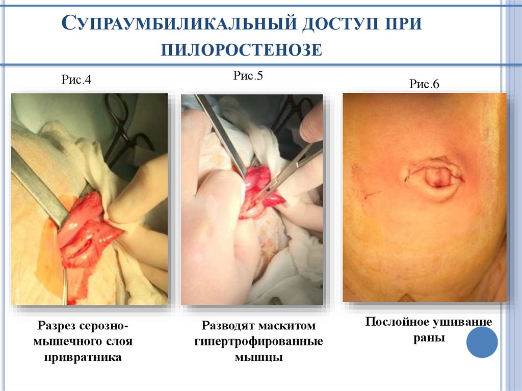 Супраумбиликальный доступ при пилоростенозе