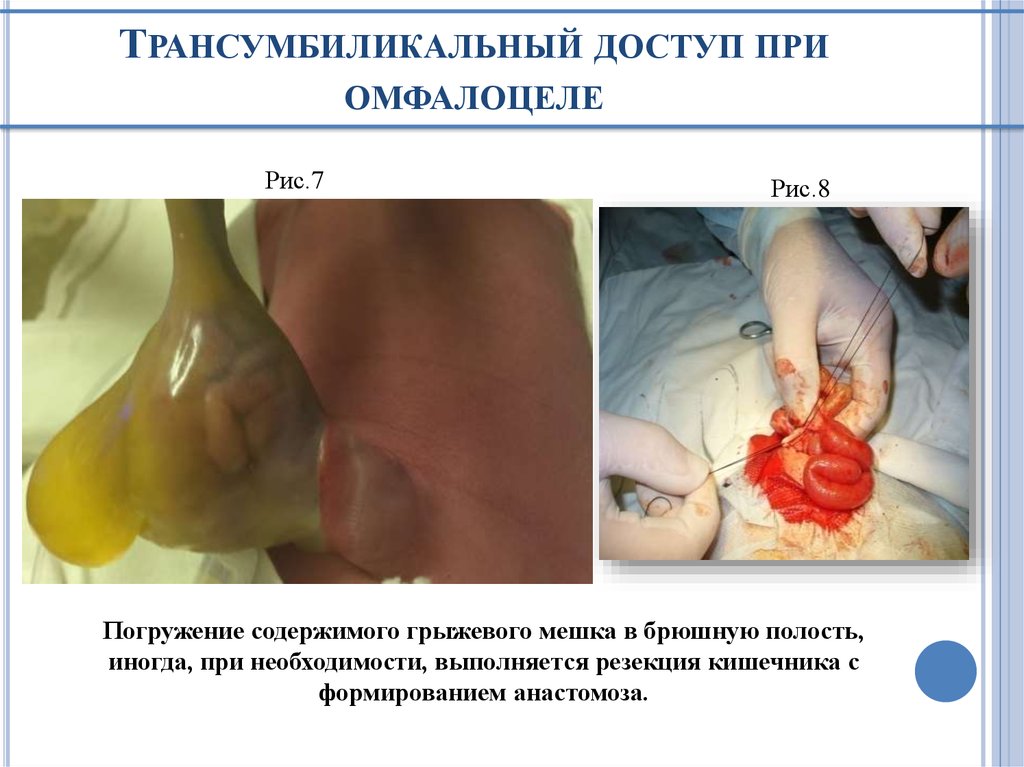 Трансумбиликальный доступ при омфалоцеле