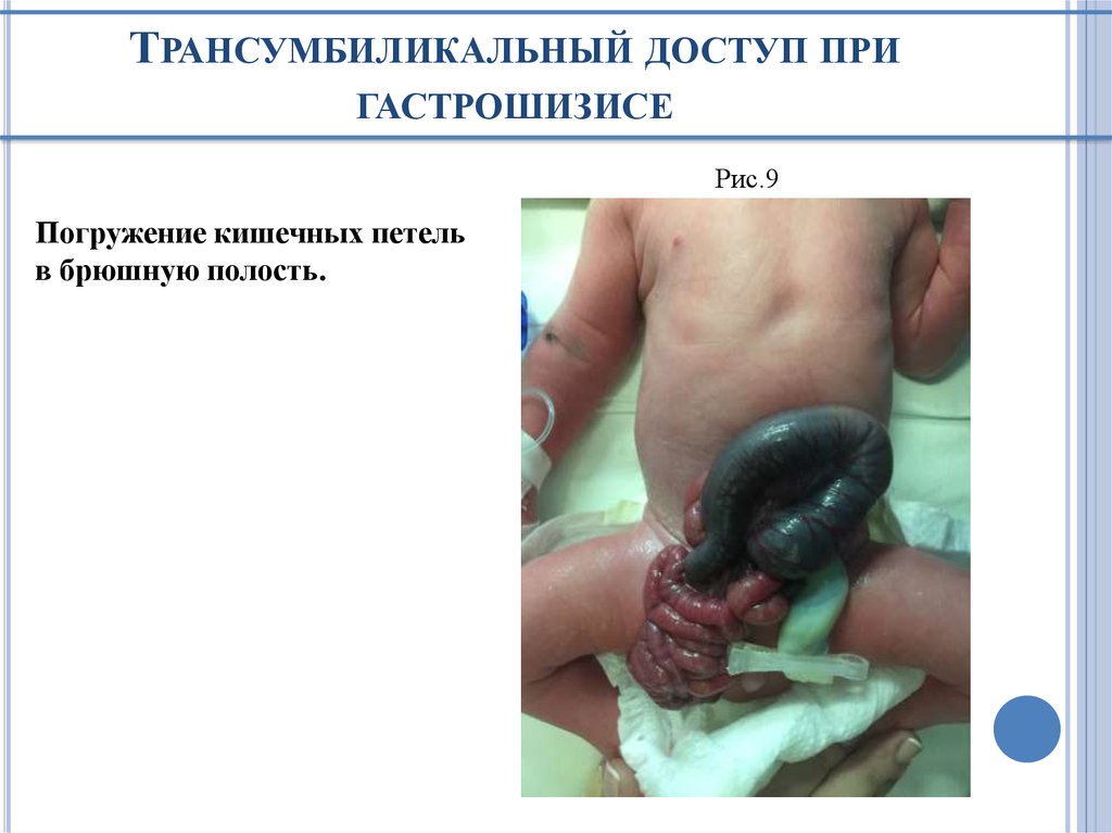 Трансумбиликальный доступ при гастрошизисе
