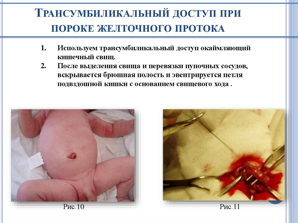 Трансумбиликальный доступ при пороке желточного протока