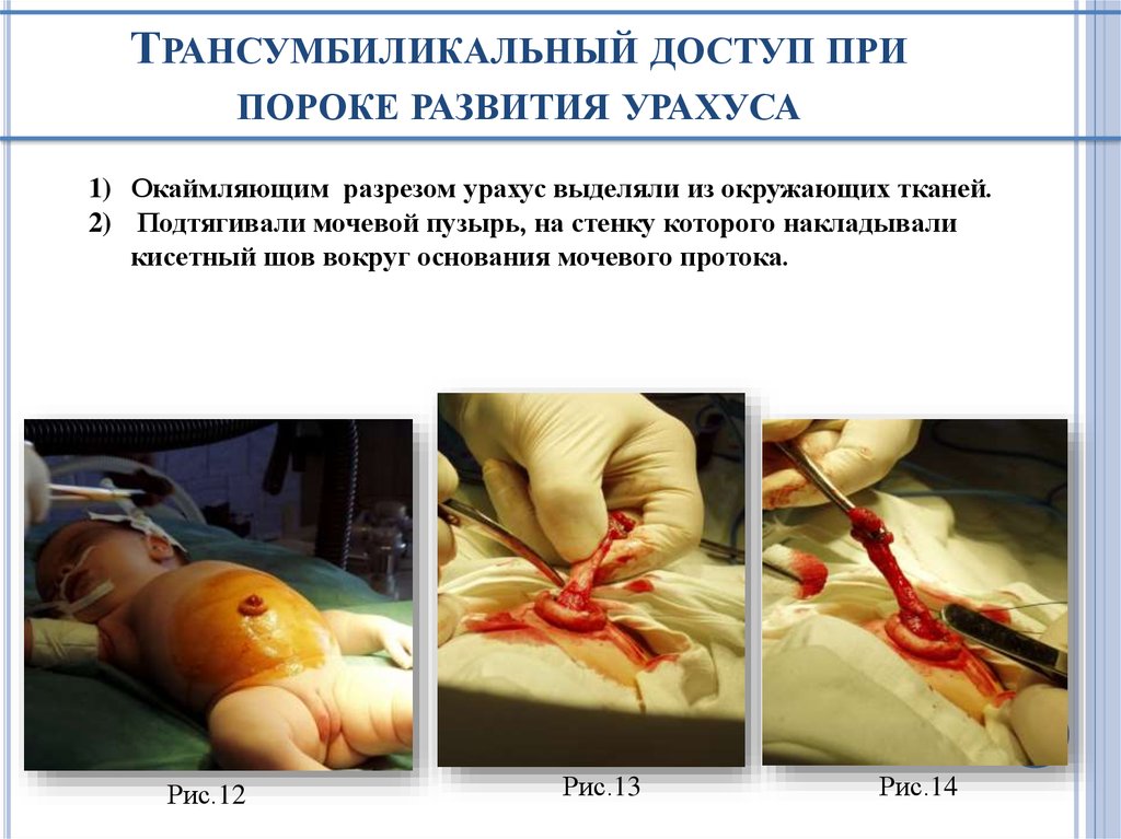 Трансумбиликальный доступ при пороке развития урахуса