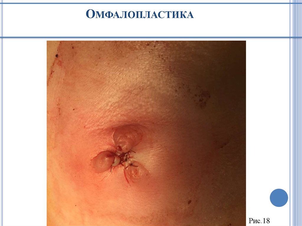 Омфалопластика