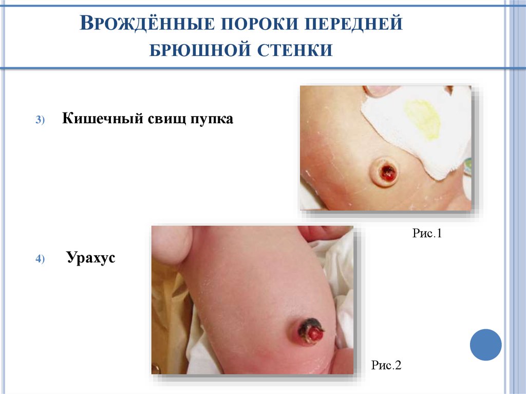 Врождённые пороки передней брюшной стенки