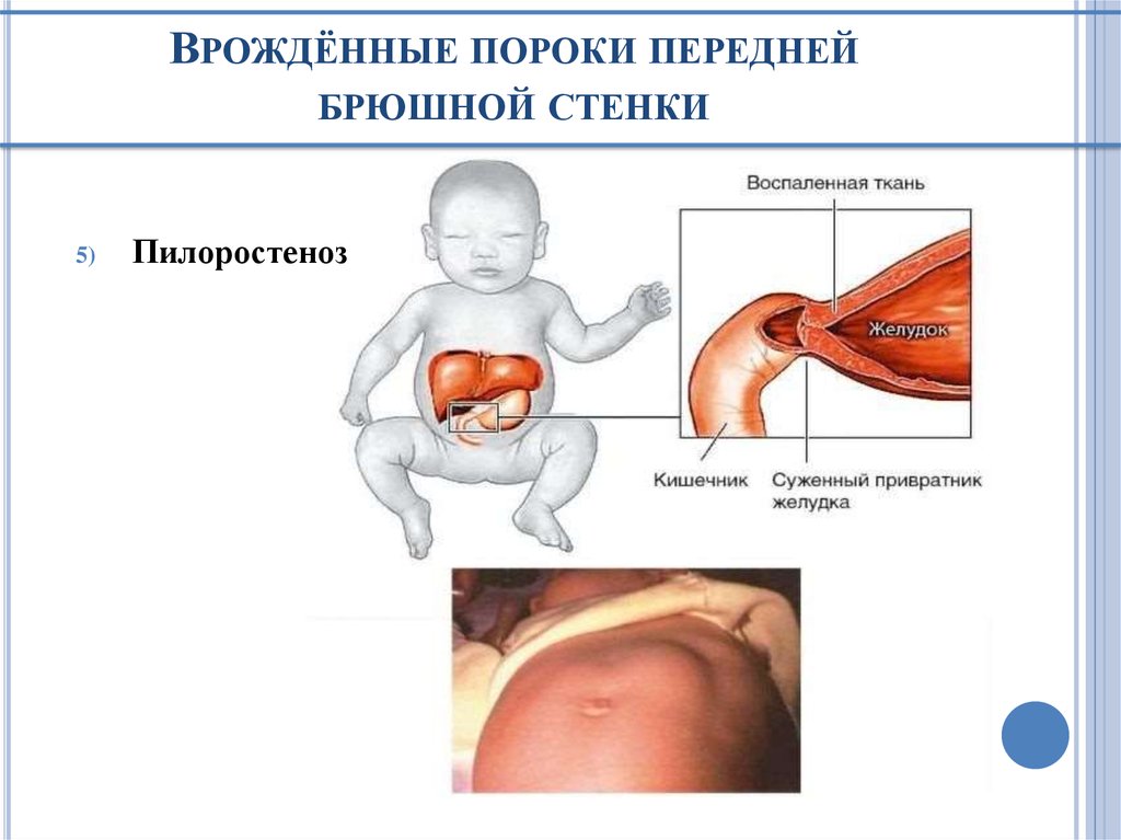 Врождённые пороки передней брюшной стенки