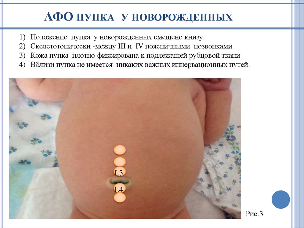 АФО пупка у новорожденных