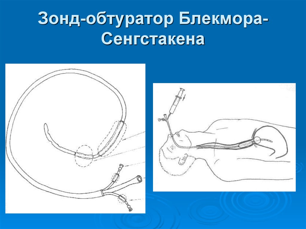 Операция зонд. Зонд обтуратор т.Блэкмора 18. Зонд обтуратор Блэкмора. Зонд Блекмора пищеводно- желудочный. Зонда-обтуратора Сенгстакена-Блэкмора.