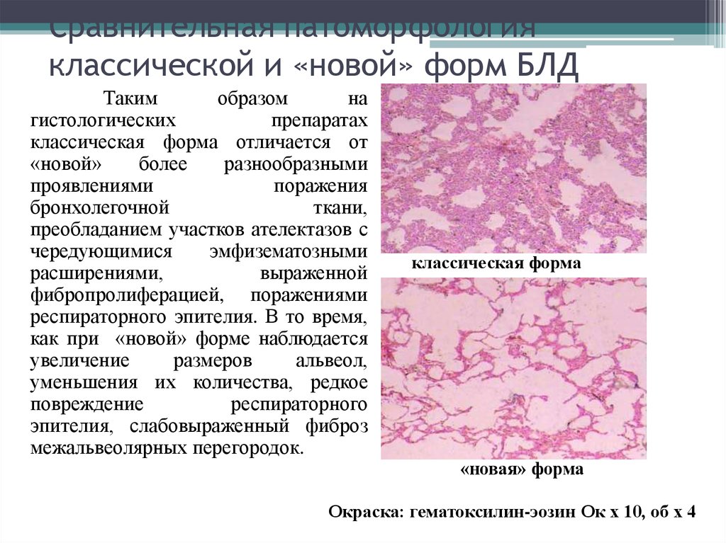 Бронхолегочная дисплазия презентация