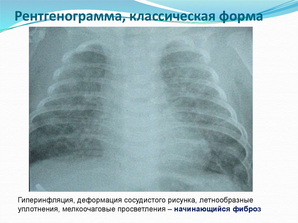 Острая деформация сосудистого рисунка легких у ребенка что это значит