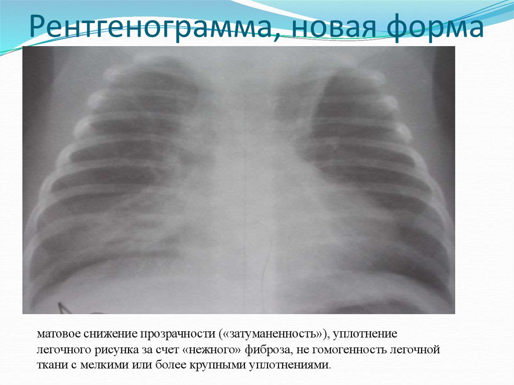 Бронхолегочная дисплазия презентация