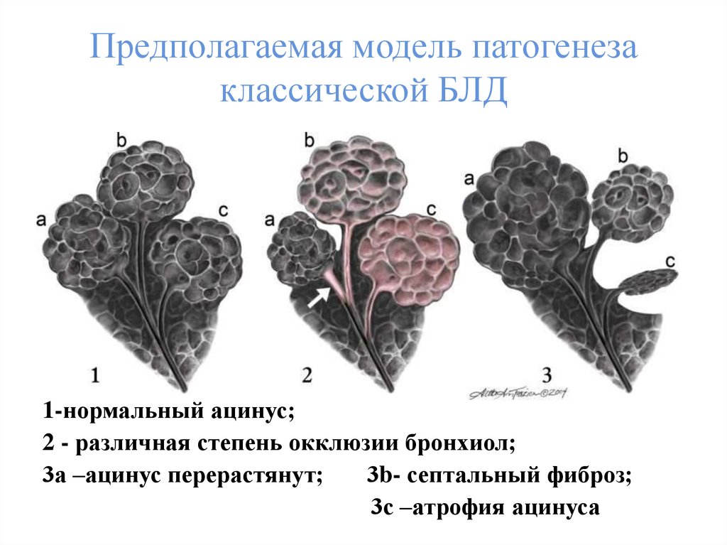 Бронхолегочная дисплазия презентация