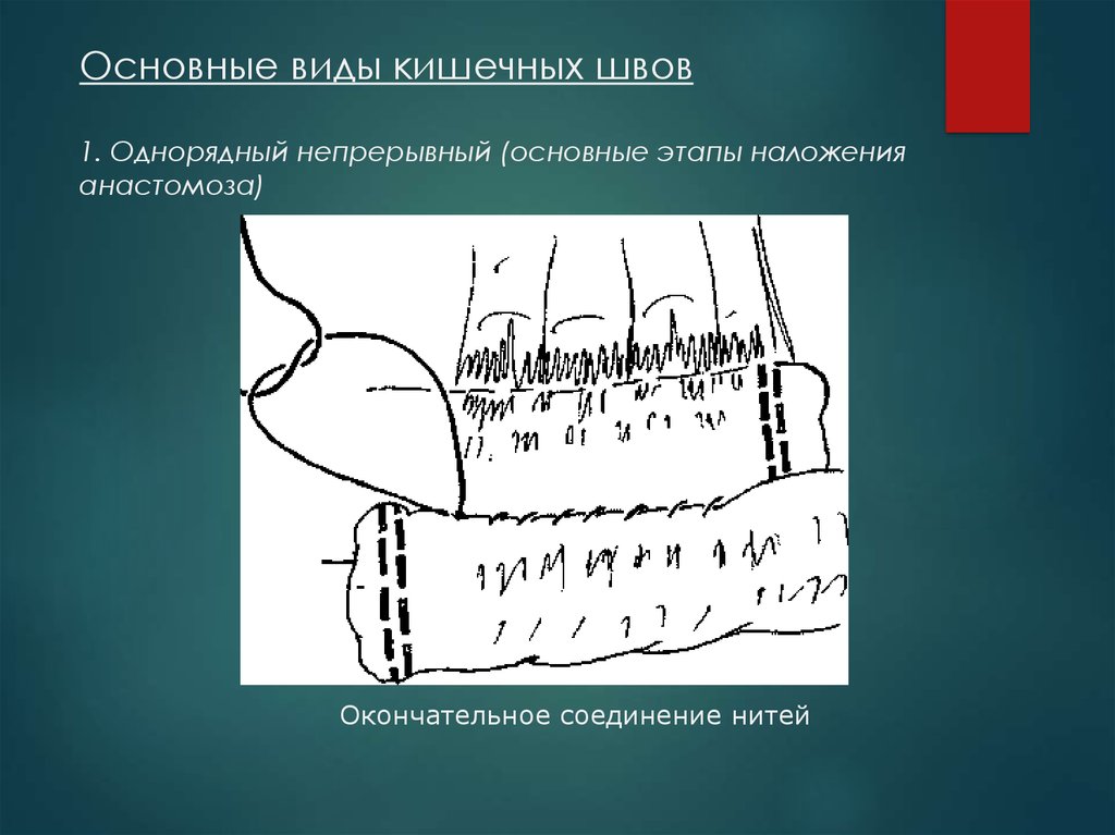 Кишечный шов. Однорядный непрерывный кишечный шов. Однорядный непрерывный шов тонкой кишки. Основные виды кишечных швов. Механический кишечный шов.