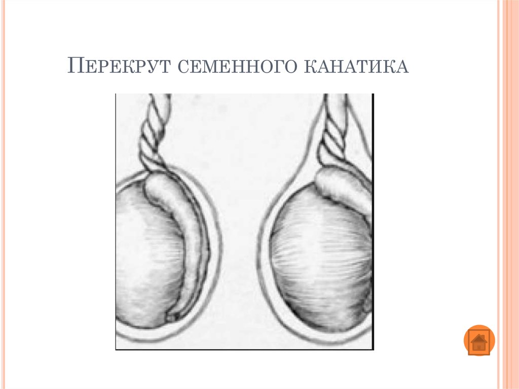 Канатик яичка. Перекручивание семенного канатика. Перекрут семенного канатика симптомы.