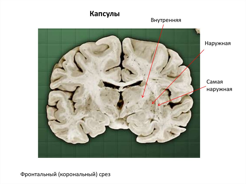 Изменение в базальных отделах. Хвостатое ядро мрт анатомия. Базальные ганглии головного мозга. Базальные ганглии анатомия. Бледный шар скорлупа хвостатое ядро.