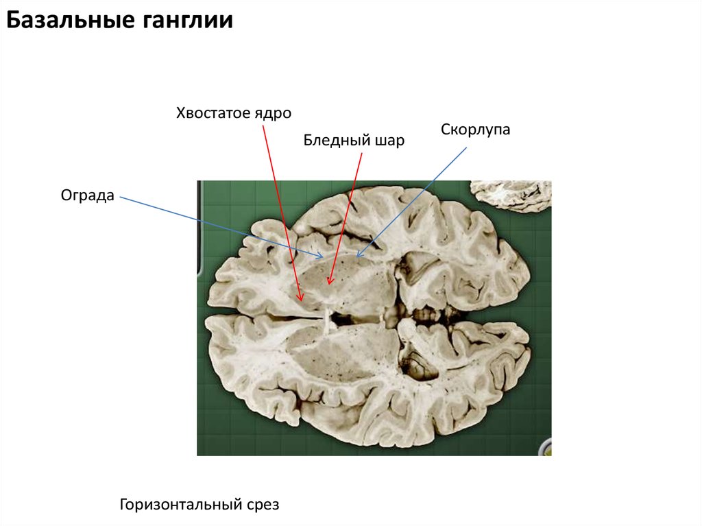 Хвостатое ядро мозга. Бледный шар скорлупа хвостатое ядро. Хвостатого ядра и скорлупы базального ганглия.. Хвостатое ядро анатомия на кт. Подкорковые ядра головного мозга анатомия.