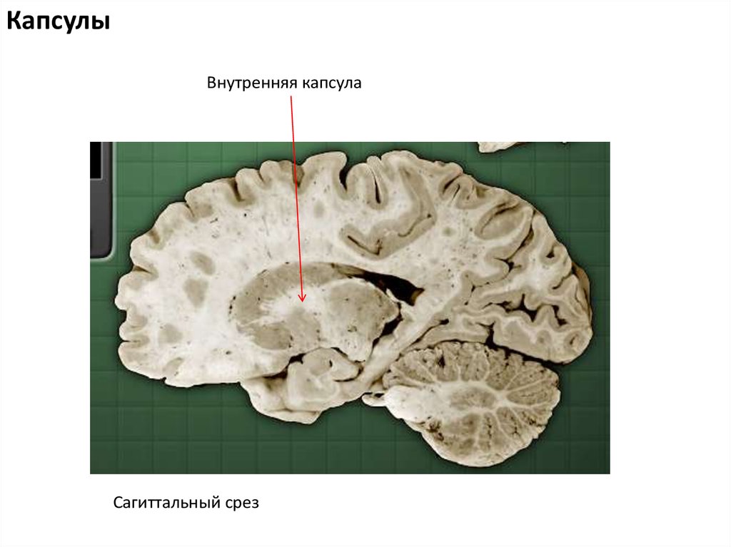 Изменение в базальных отделах. Хвостатого ядра и скорлупы базального ганглия.. Базальные ганглии анатомия. Базальные ядра конечного мозга анатомия. Подкорковые ядра головного мозга анатомия.