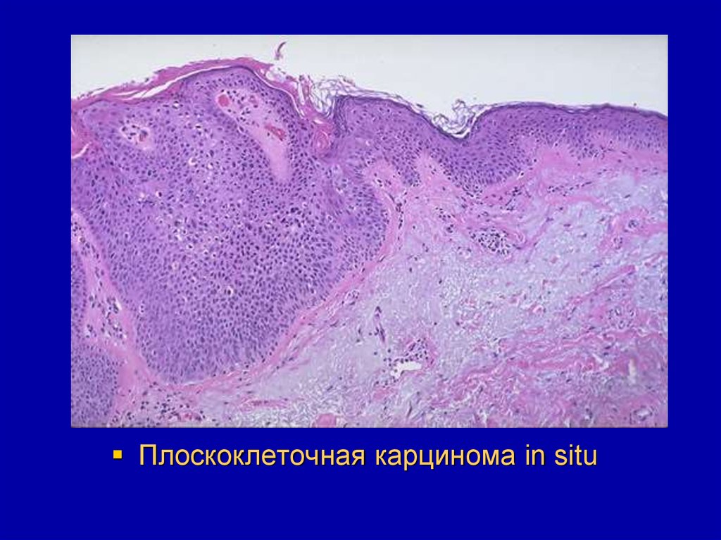 Плоскоклеточная карцинома in situ. Плоскоклеточная карцинома и аденокарцинома. Веррукозная плоскоклеточная карцинома.