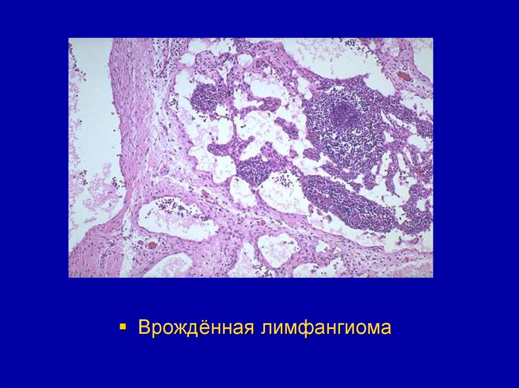 Лимфангиома. Лимфангиома гистология. Лимфангиомы слюнных желез. Лимфангиосаркома гистология. Лимфангиома патологическая анатомия.