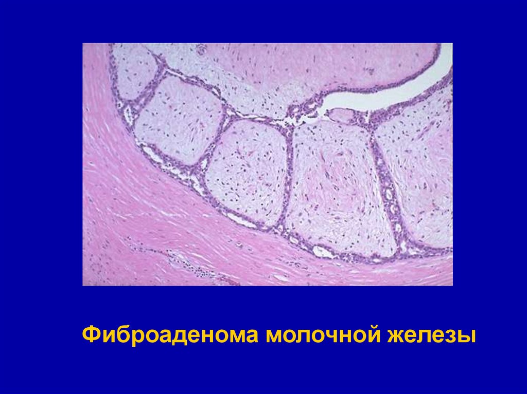 Производные тканей. Интраканаликулярная фиброаденома молочной железы микропрепарат. Периканаликулярная фиброаденома молочной железы. Фиброаденома молочной железы микропрепарат рисунок.