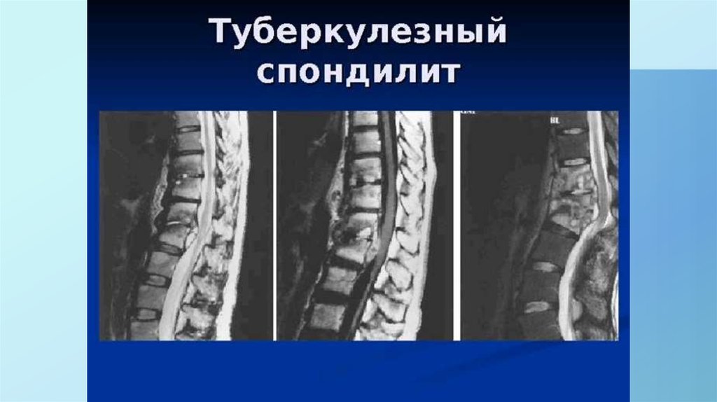 Симптом вожжей. Спондилит позвонков на кт. Асептический спондилодисцит l5-s1. Туберкулезный спондилит позвоночника кт. Спондилит поясничного отдела кт.