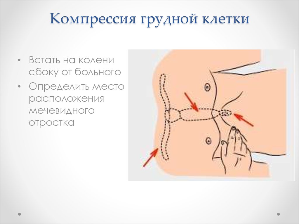 Компрессия грудной клетки. Точка компрессии грудной клетки.