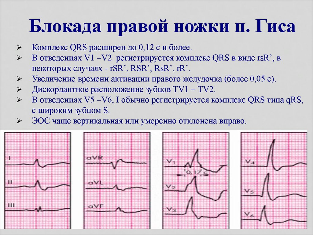 Лечение нарушения внутрижелудочковой проводимости на экг