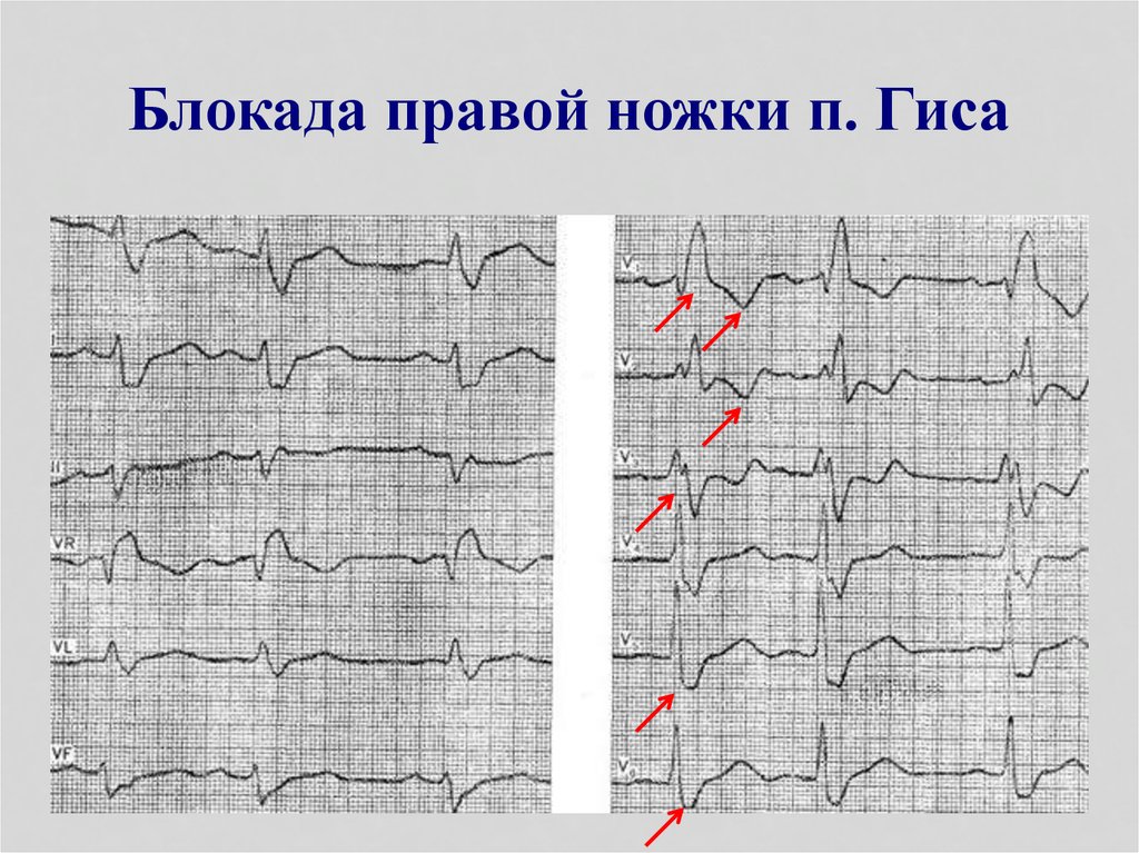 Местные нарушения внутрижелудочковой проводимости на экг