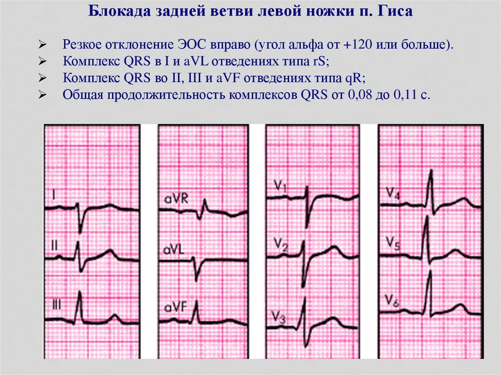 Передняя левая ножка гиса. Блокада задней ножки пучка Гиса на ЭКГ. Блокада левой задней ветви пучка Гиса на ЭКГ. Блокада левой задней ножки пучка Гиса. Блокада задней ветви левой ножки пучка Гиса на ЭКГ.