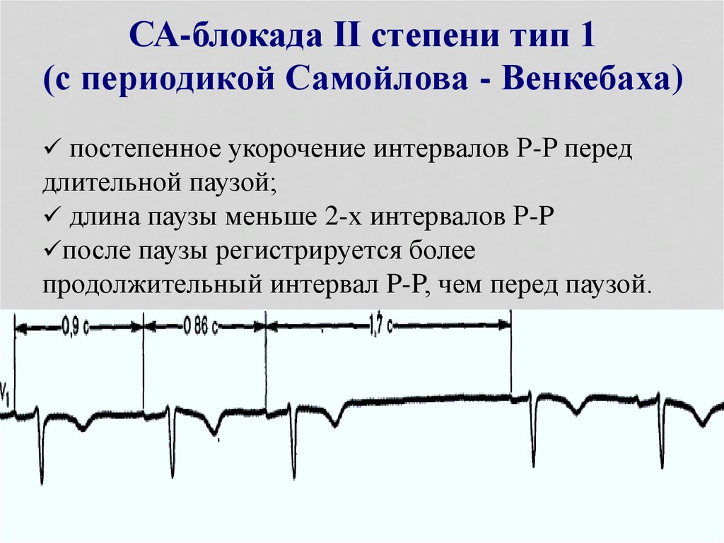 Местные нарушения внутрижелудочковой проводимости на экг