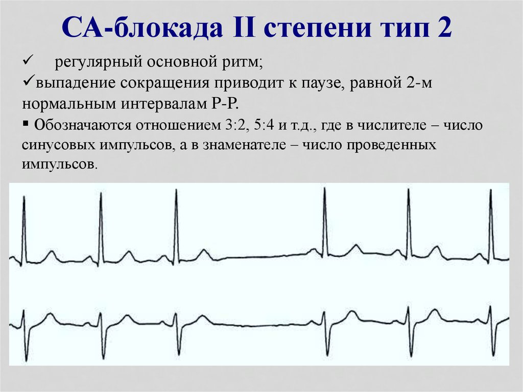 Блокада болезнь. Синусовая блокада 3 степени. Са блокада II степени 1 типа. Синоатриальной блокады сердца. ЭКГ признаки синоатриальной блокады.