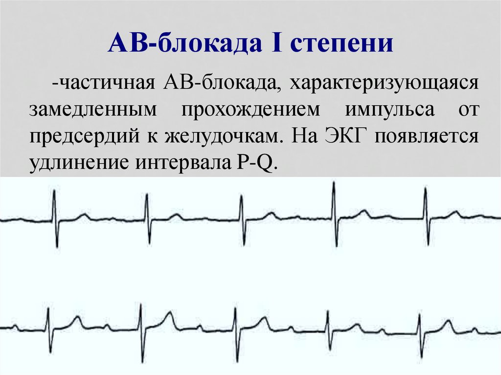 Синоатриальная блокада 2 степени 2 типа. Са блокада 3 степени. Тахикардии с блокадой са. Синоатриальная блокада причины. ЭКГ при са блокаде и тахикардии.