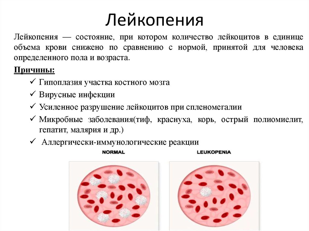 Причины нарушения крови. Лейкопения при инфекционных заболеваниях. При острых инфекционных заболеваниях число лейкоцитов в крови. Картина крови при лейкопении. Наиболее часта форма лейпонии.