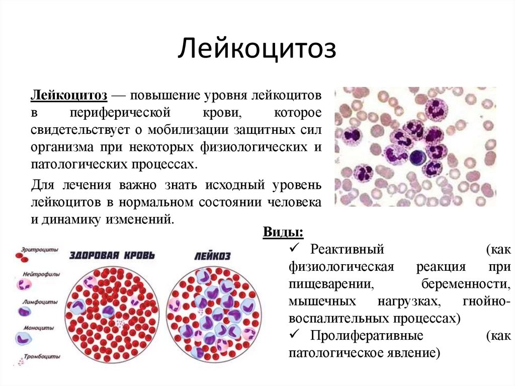 Повышение лейкоцитов в крови у мужчин. Острый лейкоцитоз крови показатели. Уменьшение содержания в крови нормальных лейкоцитов. Патология крови лейкоцитозы. Болезни при повышении лейкоцитов.