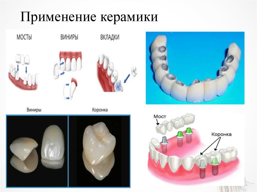 Презентация керамика в стоматологии