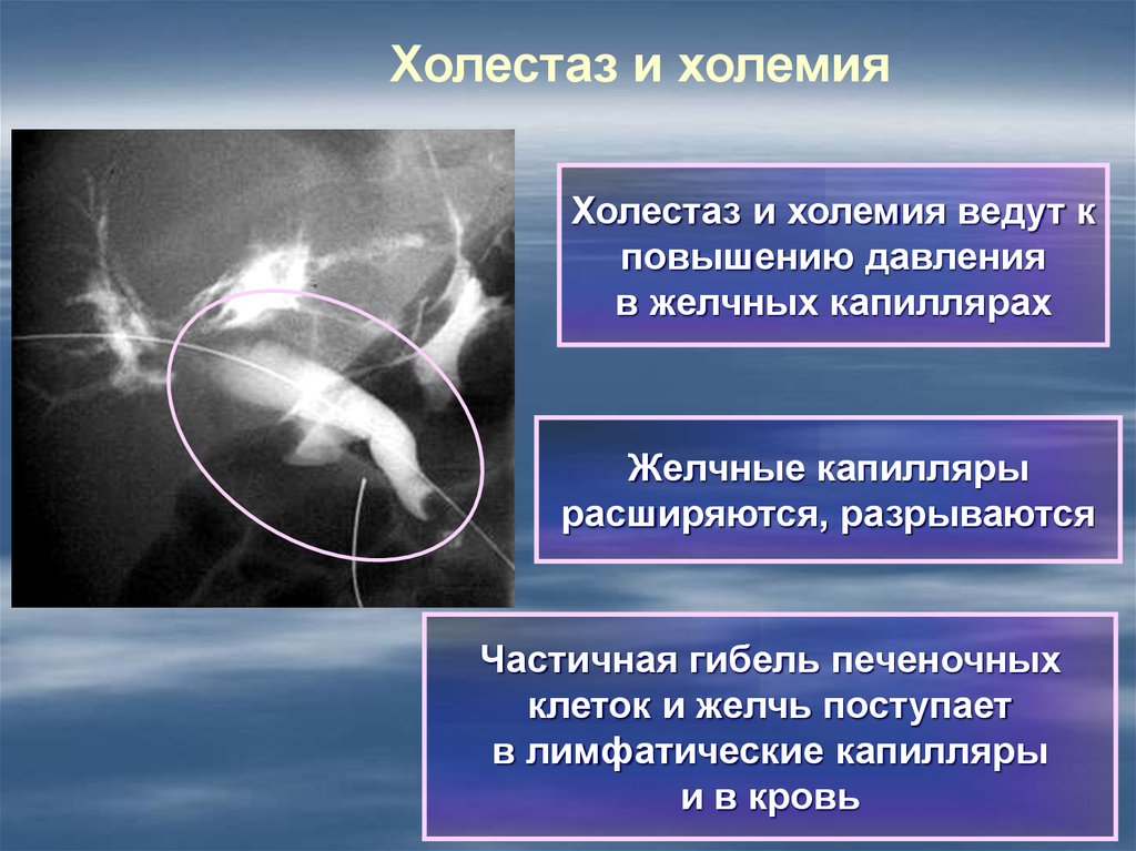 Для эхографической картины острого холецистита характерно тест ответ