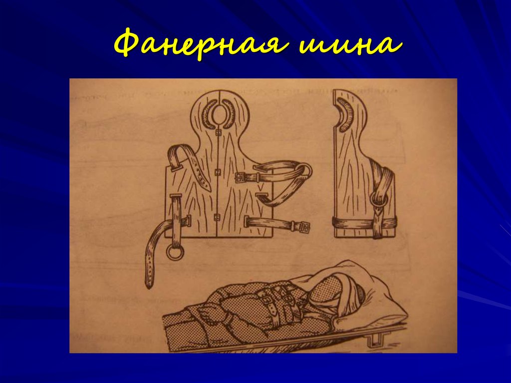 Иммобилизация в травматологии - online presentation