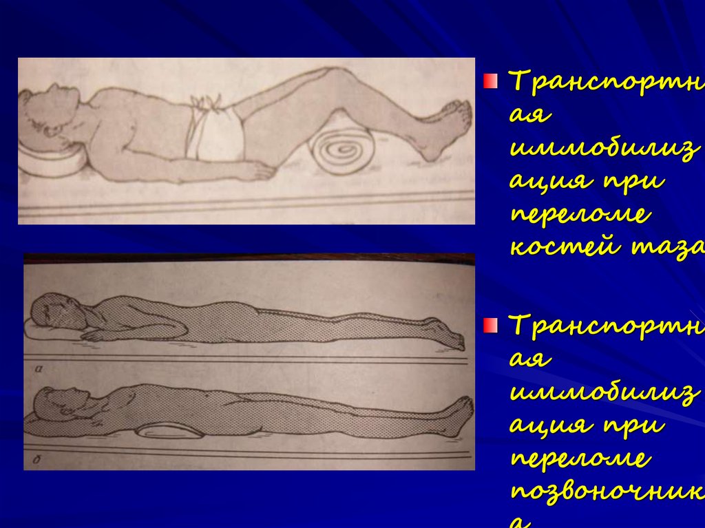 Иммобилизация в травматологии - online presentation