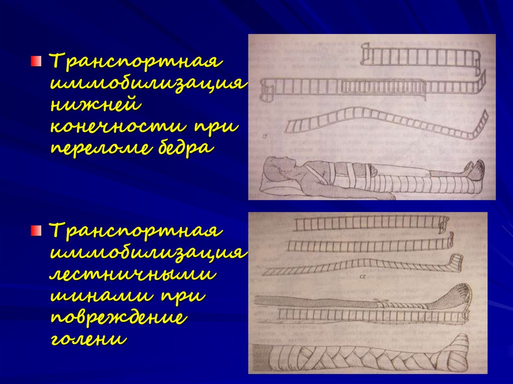 Постоянная иммобилизация презентация