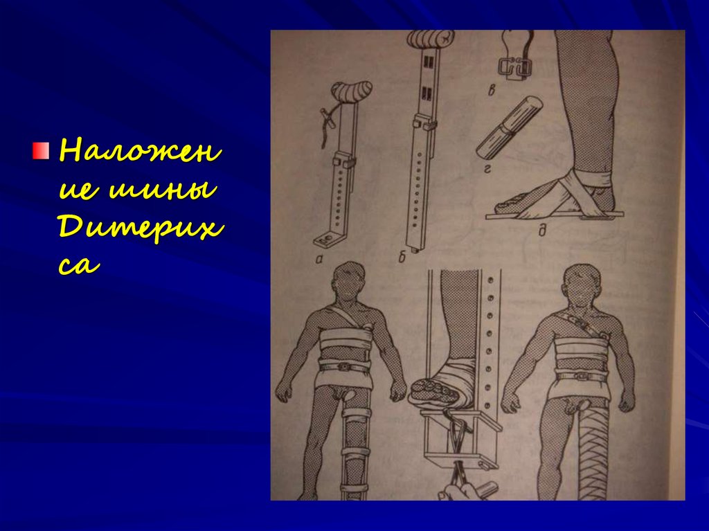 Иммобилизация в травматологии - презентация онлайн