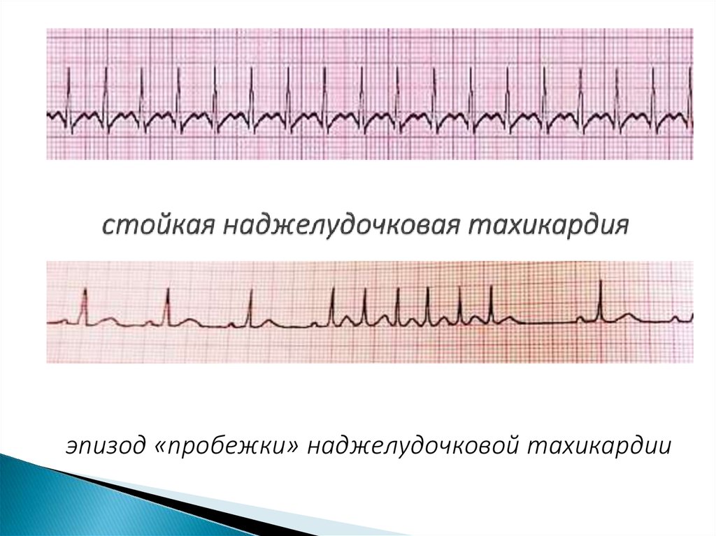 Наджелудочковая тахикардия презентация