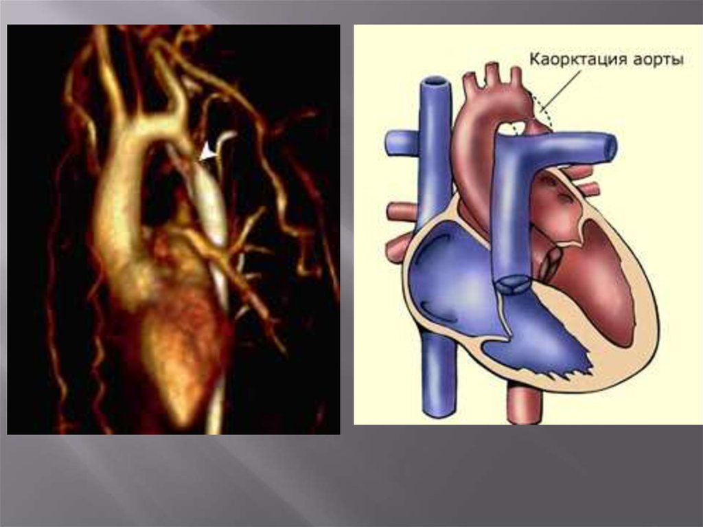 Коарктация аорты картинки