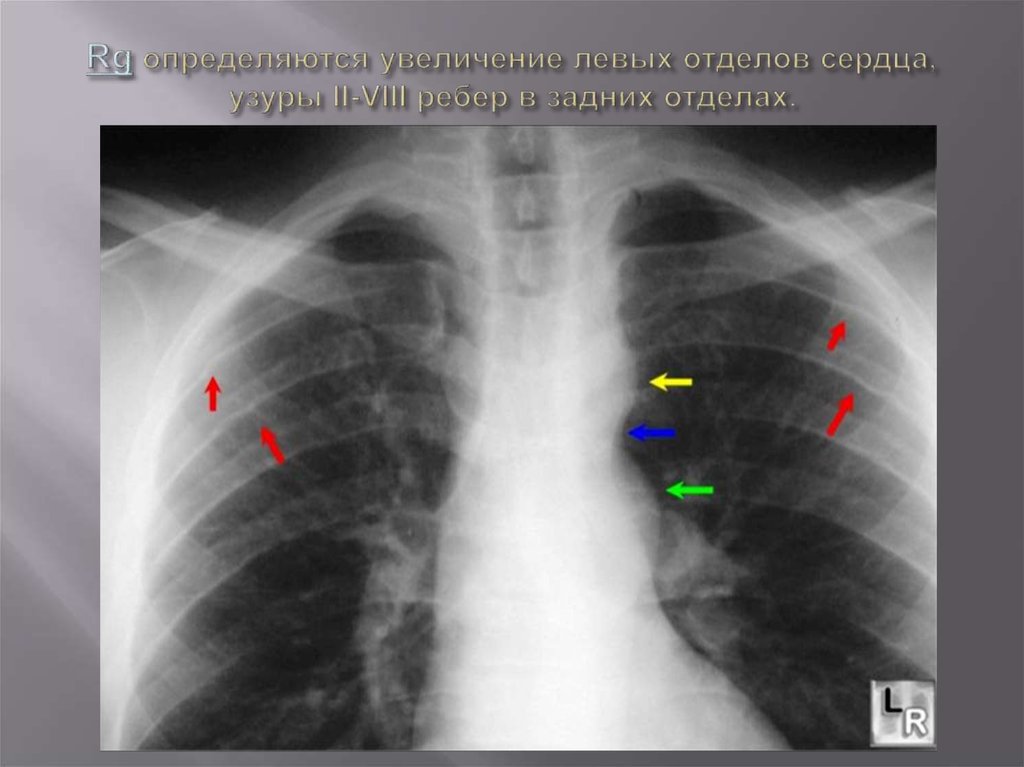 Rg определяются увеличение левых отделов сердца, узуры II-VIII ребер в задних отделах.