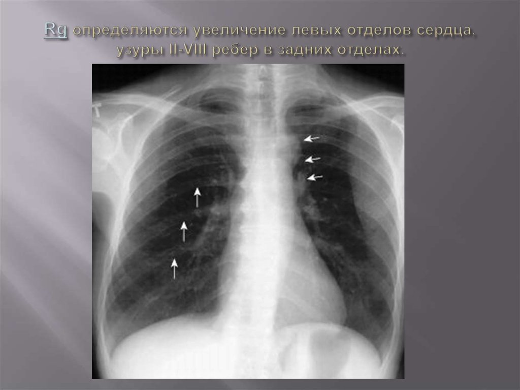 Левых отделов. Коарктация аорты Узуры. Коарктация аорты ребра рентген. Коарктация аорты Узуры ребер. Узуры на Нижнем крае ребер.